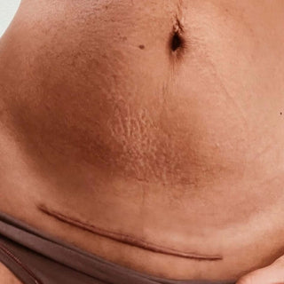 Caesarean section scar